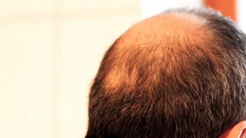Tipp für mehr Haare - Gegen Haarausfall