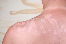 Achtung UV: Die 7 besten Tipps gegen Sonnenbrand