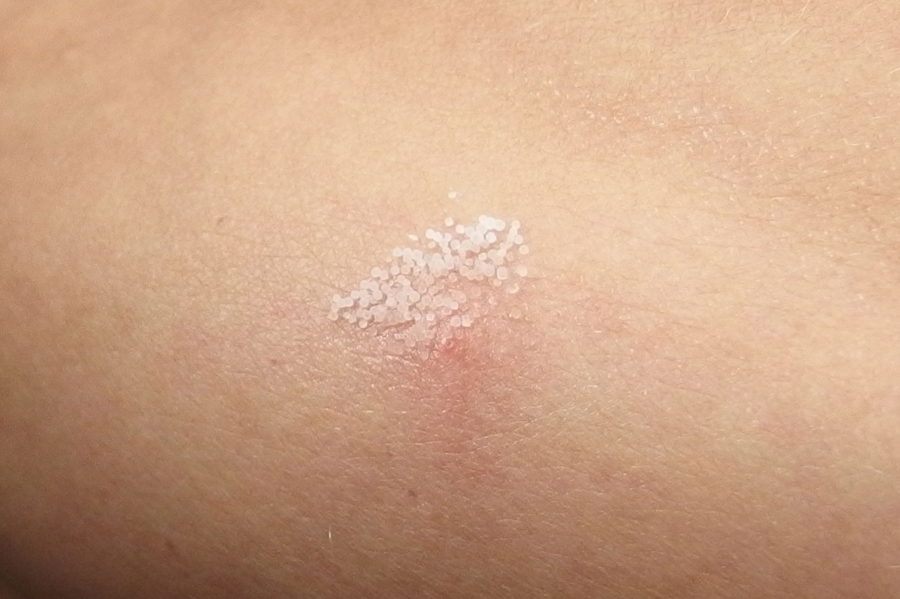 Narben behandeln mückenstich Narben: So