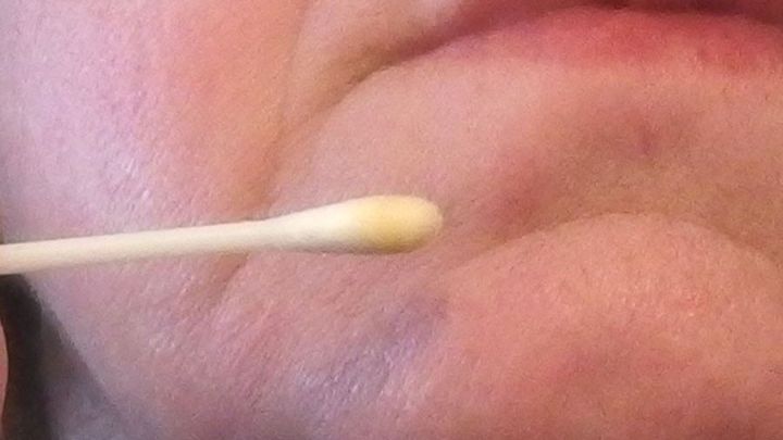 Ein Cottontip wird auf eine Hautstelle auf dem Kinn aufgetragen, um Propolis gegen Pickel im Gesicht zu verwenden.