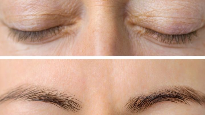 Eine Nahaufnahme von Augenlidern zeigt den Vergleich zwischen Schlupflidern mit Falten und glatter Haut ohne Falten.