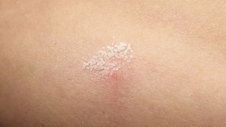 Auf der Haut ist ein blasser, juckender M&uuml;ckenstich zu sehen, der mit Salz behandelt wird, um die Symptome zu lindern.