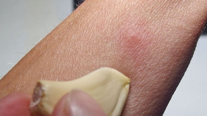 Eine Knoblauchzehe wird auf eine M&uuml;ckenstichstelle auf dem Unterarm gerieben, um Linderung zu erzielen.