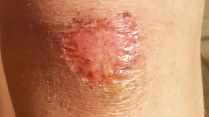 Eine gesch&auml;digte Hautstelle mit offener Wunde zeigt R&ouml;tungen und eine trockene Oberfl&auml;che, die auf Heilungsprozess hinweist.