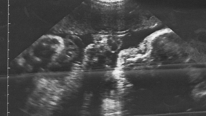 Ein Ultraschallbild zeigt das ungeborene Baby in einer Geb&auml;rmutter, umgeben von umgebenden Geweben und Fl&uuml;ssigkeit.