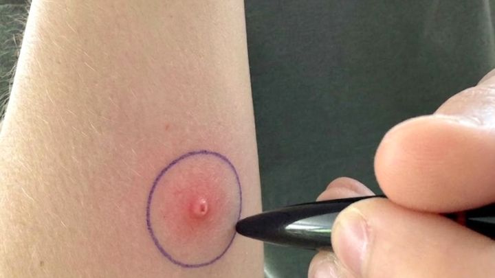 Mit einem Kugelschreiberkreis beh&auml;ltst Du bei Insektenstichen wie auf dem Bild die Schwellung besser im Blick.