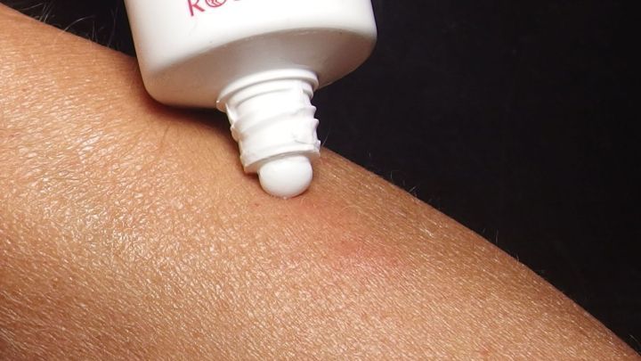 Eine Tube Zahnpasta lehnt &uuml;ber einem Arm, w&auml;hrend sie eine kleine Menge auf einen M&uuml;ckenstich auftr&auml;gt, um Linderung zu bieten.