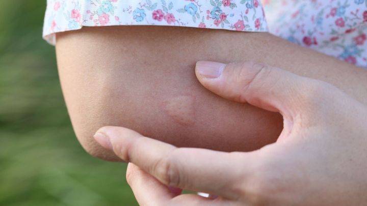 Eine Hand ber&uuml;hrt einen M&uuml;ckenstich am Unterarm, w&auml;hrend im Hintergrund eine gr&uuml;ne Wiese zu sehen ist.