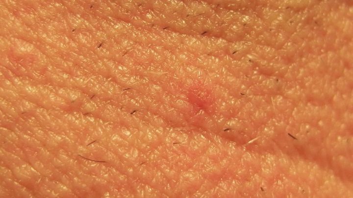 Ein roter Pickel ist auf einer Nahaufnahme von Haut zu sehen, die glatt und texturiert wirkt, wobei die Poren sichtbar sind.