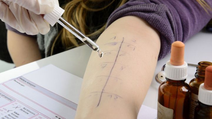 Ein Arm mit markierten Bereichen erh&auml;lt mit einer Pipette Fl&uuml;ssigkeit f&uuml;r einen Allergietest. Im Hintergrund stehen Fl&auml;schchen.