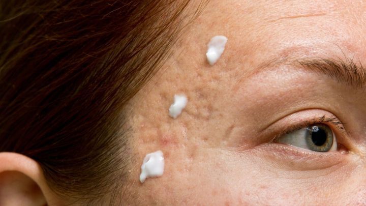 Eine Frau tr&auml;gt Epiduo-Creme gezielt auf ihre Pickel auf der Stirn auf, um Hautunreinheiten zu behandeln.