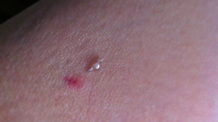 Ein Hautausschlag zeigt einen kleinen Splitter, der aus der Haut herausragt, auf einer menschlichen Hautoberfl&auml;che.
