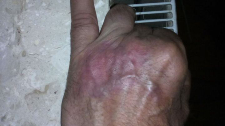 Eine Hand zeigt Symptome von Schuppenflechte, w&auml;hrend sie an einer Wand neben einem Heizk&ouml;rper ruht.