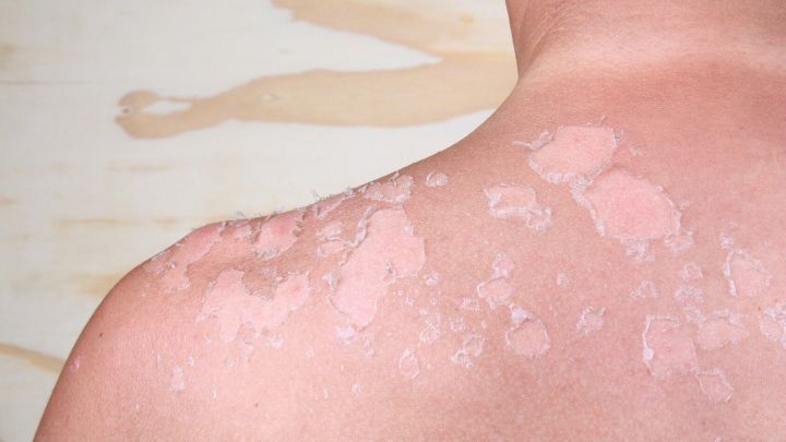 Rote, gesch&auml;digte Haut mit Sch&auml;lungen zeigt die Folgen eines Sonnenbrands auf der Schulter in einem neutralen Hintergrund.