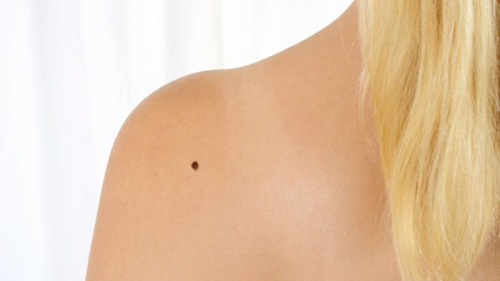 Ein heller Hautton mit einem kleinen, dunklen Muttermal auf der Schulter. Der Hintergrund ist unscharf und hell.