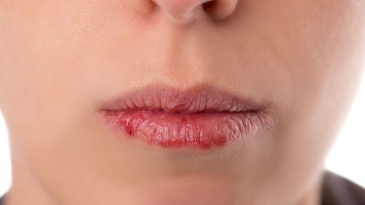 Trockene, rissige Lippen sind sichtbar, was auf Winterpflege und Feuchtigkeit hinweist. Die Haut braucht intensive Pflege.