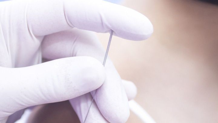 Eine Hand mit einem Nadel bewegt sich, um Dry Needling an der Schulter einer Person durchzuf&uuml;hren.