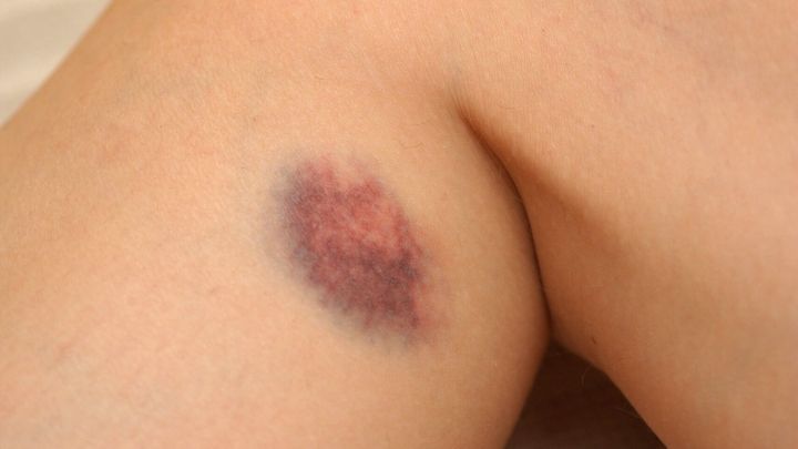 Ein blauer Fleck befindet sich auf einem Arm, zeigt eine verf&auml;rbte Stelle, die verletzt aussieht und heilt.