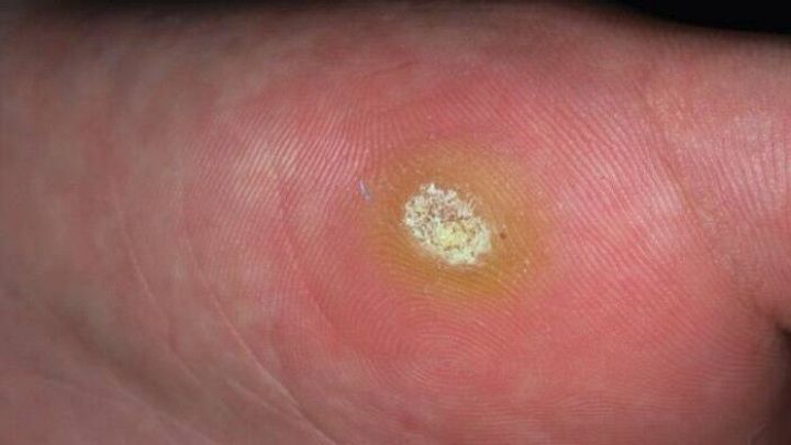 Eine Handfl&auml;che zeigt eine Dornwarze, die gelblich und erh&ouml;ht ist, im Fokus f&uuml;r Behandlungsmethoden wie rote Tinte.