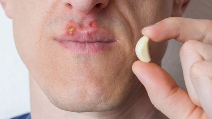 Ein Mann h&auml;lt eine Knoblauchzehe vor seinem Gesicht, das von Herpesbl&auml;schen betroffen ist.