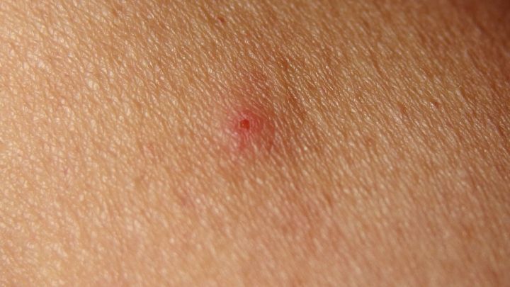 Rote Schwellung auf Haut zeigt M&uuml;ckenstich; Hautoberfl&auml;che ist deutlich sichtbar im Nahaufnahme-Kontext.