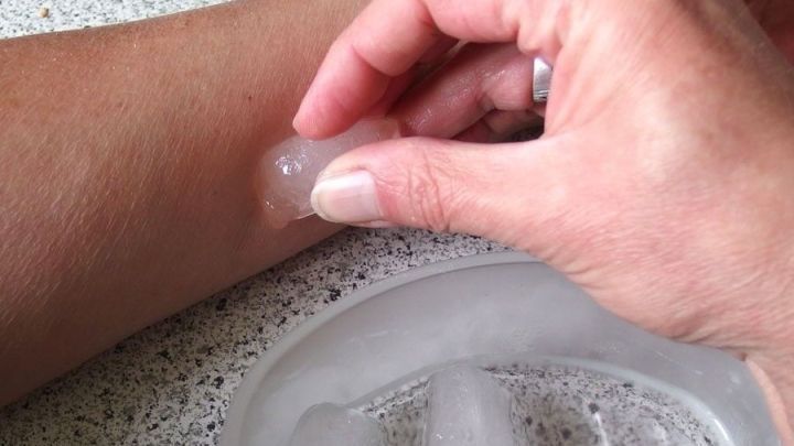 Eine Hand dr&uuml;ckt ein Eisw&uuml;rfelst&uuml;ck gegen einen M&uuml;ckenstich auf dem Unterarm, um sofortige Linderung zu erreichen.