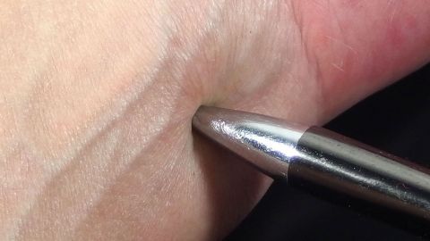Ein Kugelschreiber berührt einen Mückenstich auf einer Hand, um den Juckreiz zu lindern.