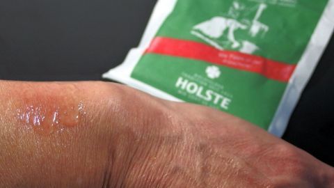 Etwas Natron (auch Speisesoda, Kaisernatron genannt) mit Wasser lindert Juckreiz nach einem Mückenstich. Eine Hand mit Rötung zeigt Natron, das gegen Jucken bei Mückenstichen angewendet wird, im Hintergrund der Beutel.