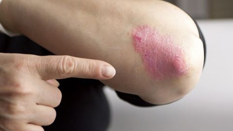 Ein Arm mit einer roten, schuppigen Stelle an einem Ellbogen wird mit einem Finger betrachtet, was auf Schuppenflechte hinweist.