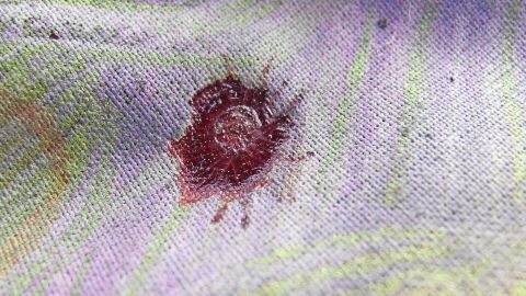 Essig-Waschmittellauge gegen frische Blutflecken auf z. B. Sofas oder Matratzen. Die Lauge hilft auch bei anderen Flecken. Ein Blutfleck auf einem farbigen Stoff, der auf einem Sofa oder einer Matratze sichtbar ist. Reinigung ist erforderlich.