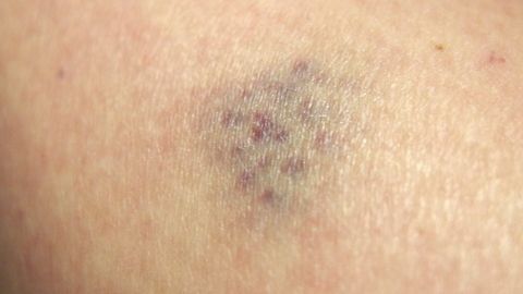 Ein blauer Fleck auf der Haut eines Kindes zeigt eine häufige Verletzung, die nach einem Sturz entstehen kann.