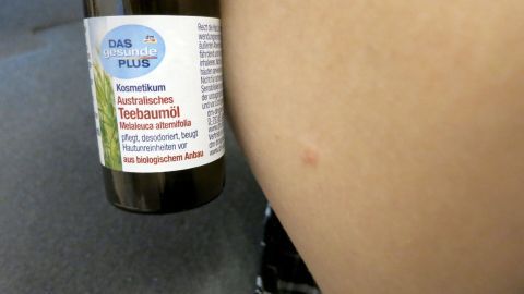 Ein Fläschchen Teebaumöl steht neben einem Insektenstich auf der Haut, das zur Linderung von Juckreiz eingesetzt wird.