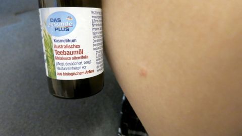 Teebaumöl bei Insektenstichen