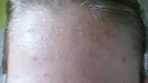 Kartoffeln können eine natürliche Lösung gegen Pickel sein. Dieses Bild zeigt Hautunreinheiten, die viele kennen. Im Artikel findest du Tipps, wie Kartoffeln helfen können, den Teint zu verbessern und Pickel zu reduzieren. Ein Gesicht mit einem sichtbaren Ansatz von Pickeln auf der Stirn, umgeben von dünnem, blondem Haar und einer grünen Wand.