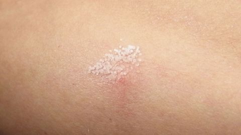 Juckreiz nach einem Mückenstich verschwinden lassen mit haushaltsüblichem Salz. Auf der Haut ist ein blasser, juckender Mückenstich zu sehen, der mit Salz behandelt wird, um die Symptome zu lindern.
