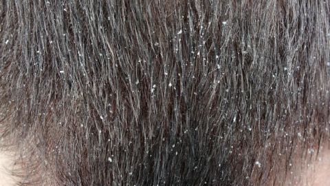 Haare bedeckt mit Schuppen, die sich im schuppig-trockenen Kontext der Kopfhaut zeigen.