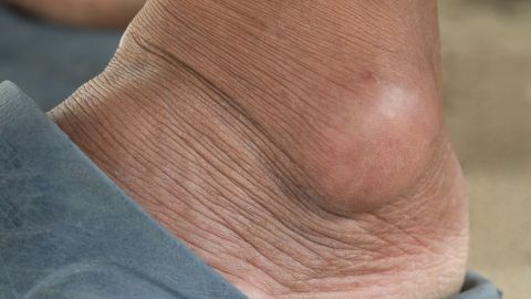 Ein Fuß mit einem deutlichen Überbein, das an der Außenseite des Knöchels sichtbar ist, während er in einem Schuh steckt.