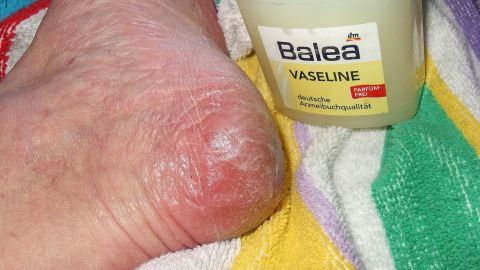 Eine trockene Ferse liegt auf einem bunten Handtuch, neben einer Dose Balea Vaseline, bereit zur Anwendung für weiche Haut.