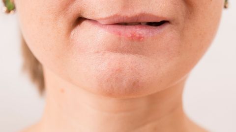 Ein Mund mit einer kleinen Herpesblase befindet sich im Vordergrund, umgeben von einer neutralen, hellen Umgebung.