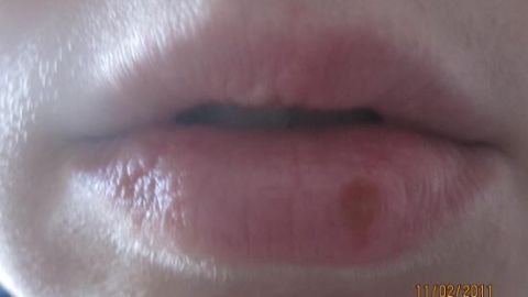 Lippen mit Herpesbläschen, Nahaufnahme, Hautunreinheit im Vordergrund. Datumsstempel unten rechts: 11/02/2011.