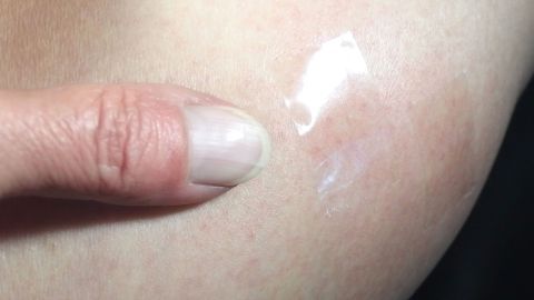 Ein Finger drückt auf ein transparentes Klebeband, das auf einer juckenden Mückenstichstelle auf der Haut haftet.