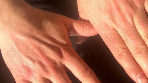 Hände mit trockener Haut liegen nebeneinander auf einer dunklen Oberfläche, zeigen deutliche raue Stellen.