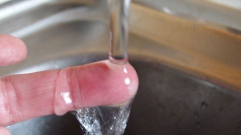 Ein Finger mit einer leichten Verbrennung wird unter kaltes Wasser gehalten, um die Schmerzen zu lindern.