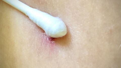 Ein Wattestäbchen wird sanft auf einen Pickel aufgetragen, der auf der Haut gerötet ist.