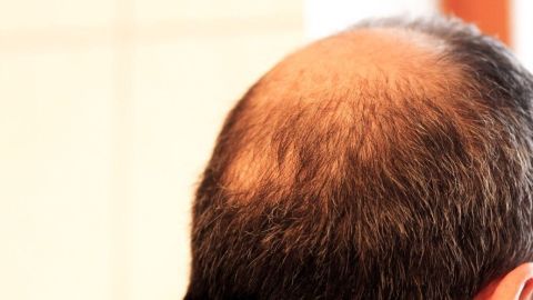Ein kahler Hinterkopf zeigt deutlichen Haarausfall, während sich der Mann in einer hellen Umgebung entspannt.