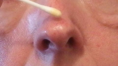 Ein Wattestäbchen wird verwendet, um Propolis auf eine kleine Entzündung an der Nase aufzutragen.