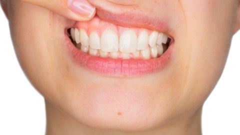 Eine Person zeigt mit dem Finger auf ihre geschwollene Mundschleimhaut, was auf Schmerzen durch Aphthen hinweist.