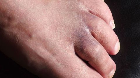 Ein verletzter Fuß mit einem Hämatom, das einen blauen Fleck zeigt, liegt auf einem dunklen Untergrund.