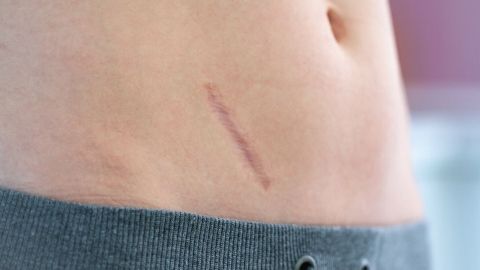 Ein Schnitt an einem Bauch zeigt eine frische Narbe, die die Pflege zur Optimierung des Heilungsprozesses benötigt.