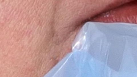 Auf der Wange liegt eine Wärmepackung, die zur Behandlung von Herpes eingesetzt wird, um die Kälte zu spüren.